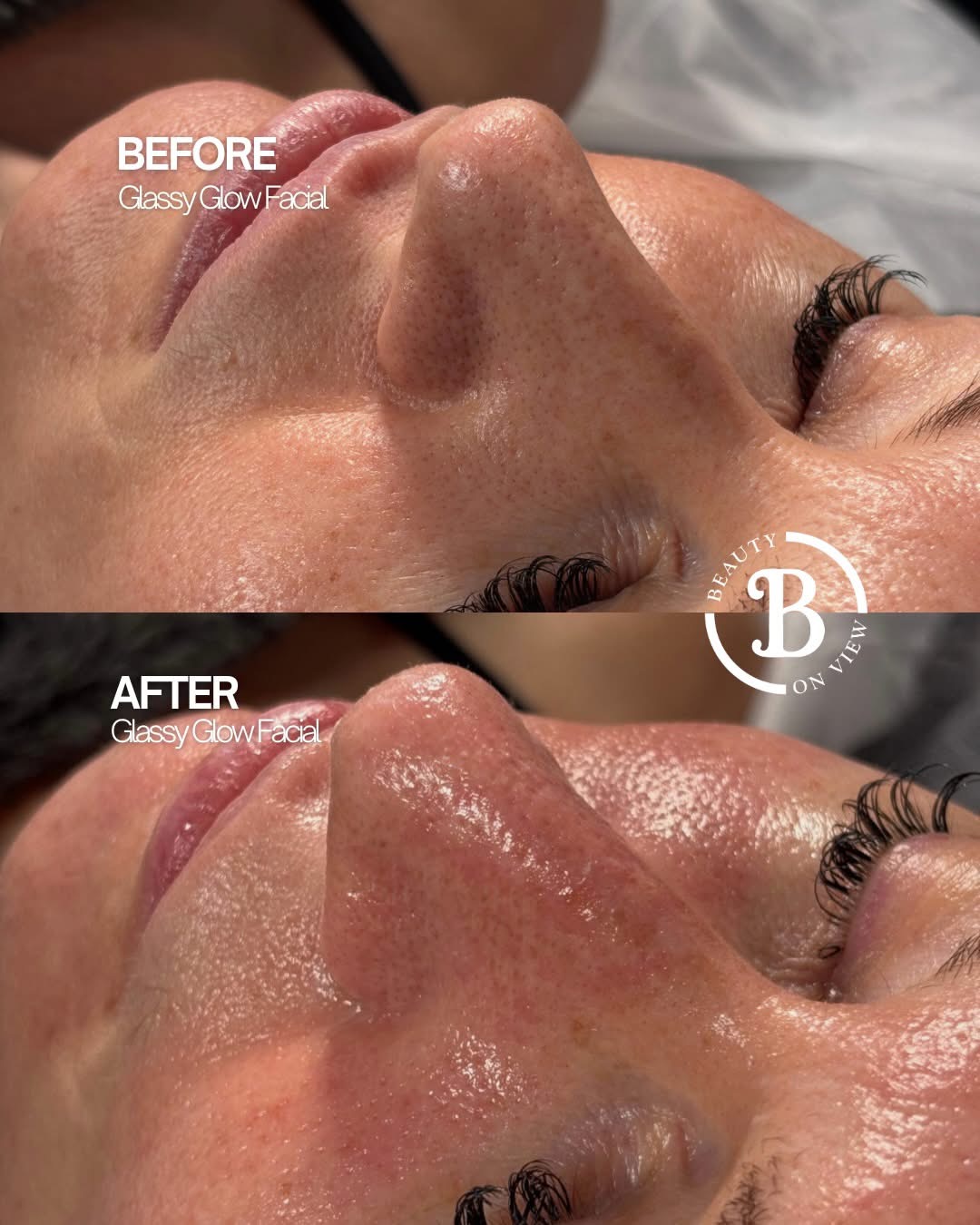 Before and after results from a Glassy Glow Facial